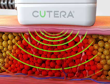 body sculpting using truSculpt ID